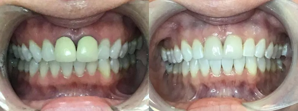 A close-up comparison of teeth mid-treatment, highlighting the gradual movement toward straightness