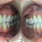 A close-up comparison of teeth mid-treatment, highlighting the gradual movement toward straightness