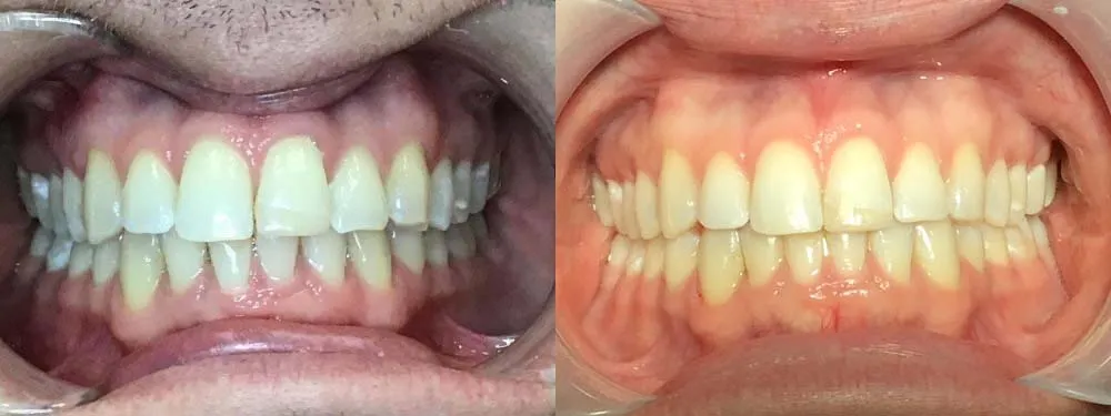 Frontal comparison focusing on the leveling of the dental midline and improved vertical alignment