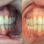 Frontal comparison focusing on the leveling of the dental midline and improved vertical alignment