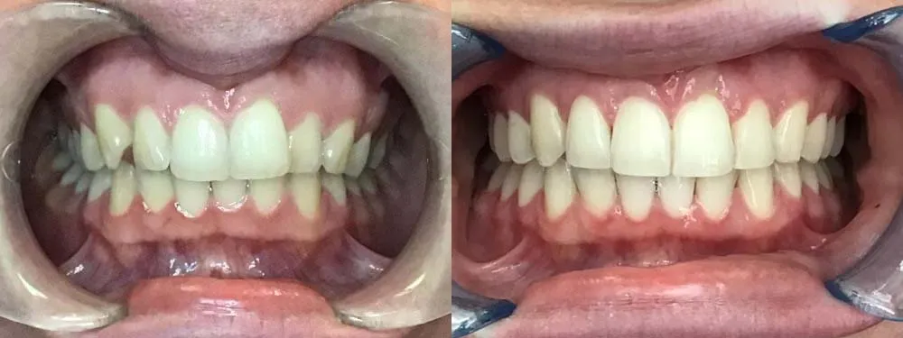 Final comparison showing a broad, symmetrical smile after completing clear aligner therapy