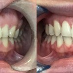 Final comparison showing a broad, symmetrical smile after completing clear aligner therapy