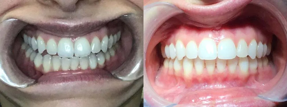 Before and after comparison showing the widening of a narrow smile and alignment of the upper and lower arches