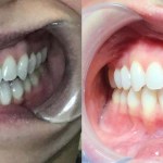 Before and after comparison showing the widening of a narrow smile and alignment of the upper and lower arches