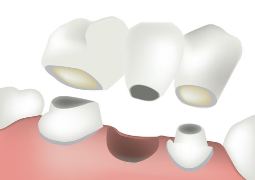 Dental bridge animation