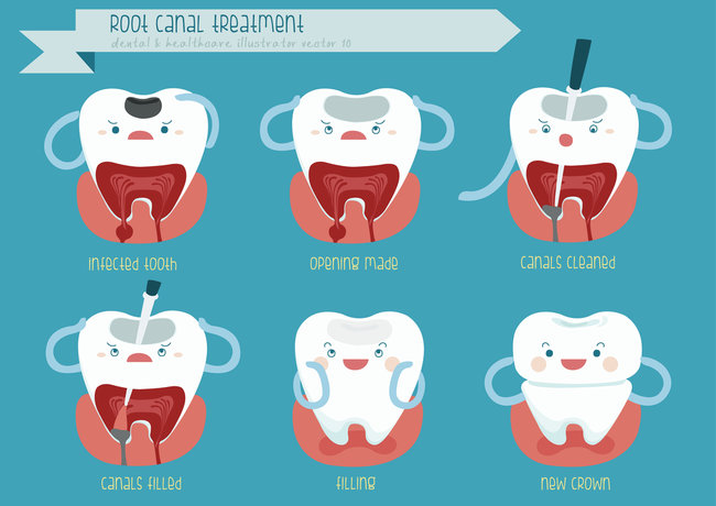 Diagram of animated root canal