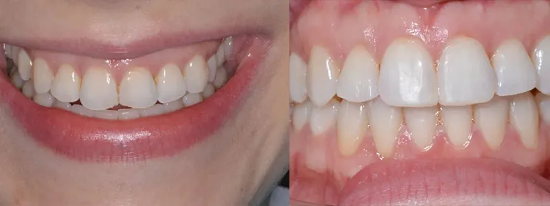 Before and after comparison showing a smile transition from naturally uneven teeth to a perfectly aligned, bright white aesthetic.