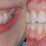 Before and after comparison showing a smile transition from naturally uneven teeth to a perfectly aligned, bright white aesthetic.