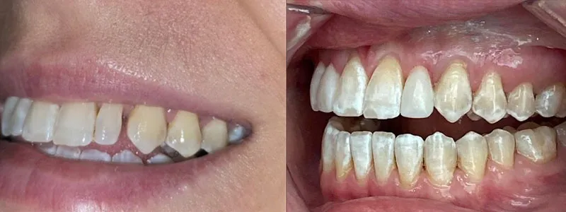 Profile view comparison showing the correction of dental crowding and the achievement of a straighter bite