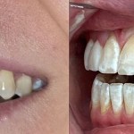 Profile view comparison showing the correction of dental crowding and the achievement of a straighter bite