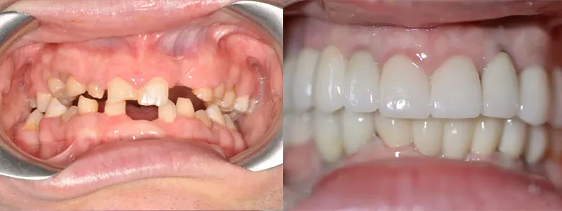 Before and after of a major dental restoration, moving from severely worn and missing teeth to a complete set of dental crowns/bridges