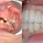 Before and after of a major dental restoration, moving from severely worn and missing teeth to a complete set of dental crowns/bridges
