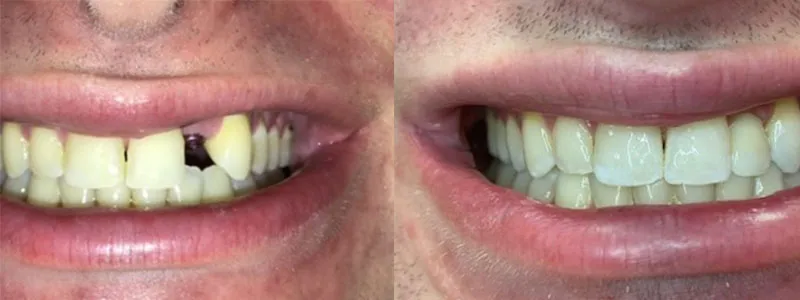 Before and after comparison of a patient with a missing front tooth and gaps, showing the finished restoration with a seamless dental implant or bridge