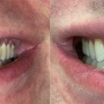 Before and after comparison of a patient with a missing front tooth and gaps, showing the finished restoration with a seamless dental implant or bridge