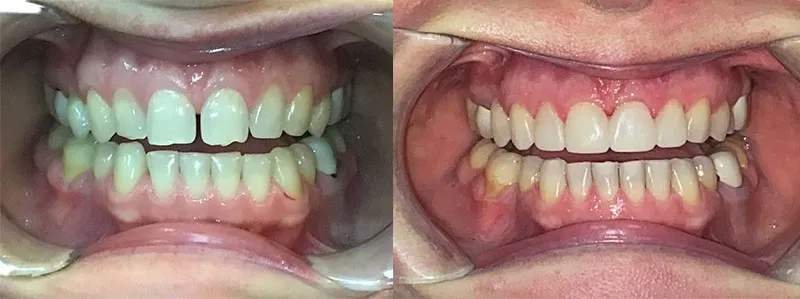 Frontal view showing the closing of a noticeable gap between the two front teeth using orthodontic treatment