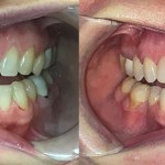 Frontal view showing the closing of a noticeable gap between the two front teeth using orthodontic treatment