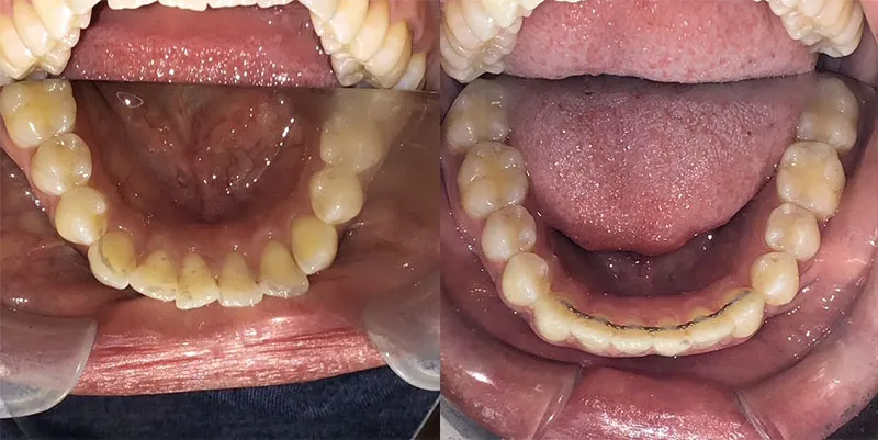 Top-down view of the lower teeth, showing the transition from crowded, overlapping teeth to a smooth, curved arch