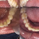 Top-down view of the lower teeth, showing the transition from crowded, overlapping teeth to a smooth, curved arch