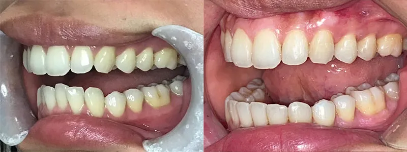 Side-angle comparison showing the correction of a significant overbite and misalignment.