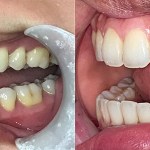 Side-angle comparison showing the correction of a significant overbite and misalignment.